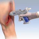 Technion Team Develops Medical Glue To Replace Stitches In Serious Injuries