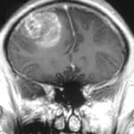 Study Reveals Surprising Discoveries About Poorly Understood Glioblastoma