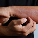 Suffering from itchy, flaky skin? Help might be on hand