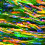 Toward a Cure for Diabetes