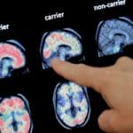 New research might explain development of Parkinson’s and Alzheimer’s